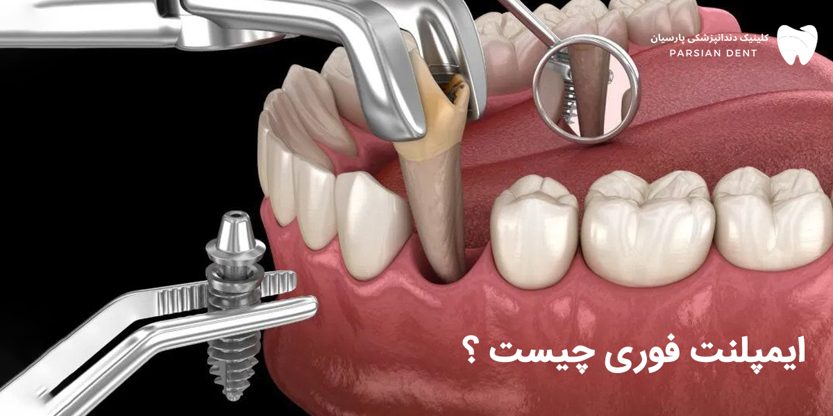 بایدها و نبایدهایی از ایمپلنت فوری که لازم است بدانید