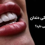 لمینت سرامیکی دندان چه ویژگی هایی دارد ؟