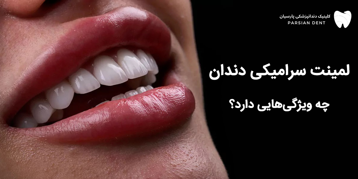 لمینت سرامیکی دندان چه ویژگی هایی دارد ؟
