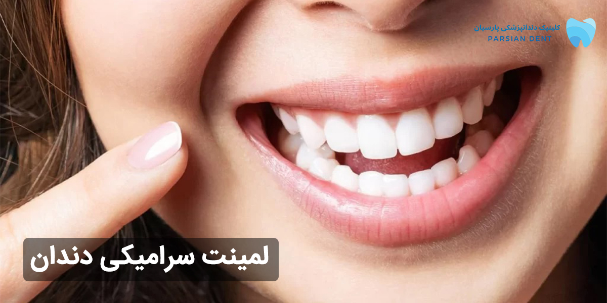 همه چیز در رابطه با لمینت سرامیکی دندان که باید بدانید
