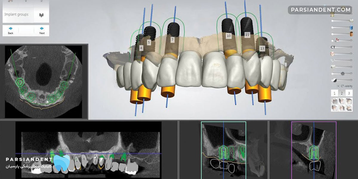 CAD/CAM ایمپلنت دیجیتال