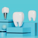 ایمپلنت فوری