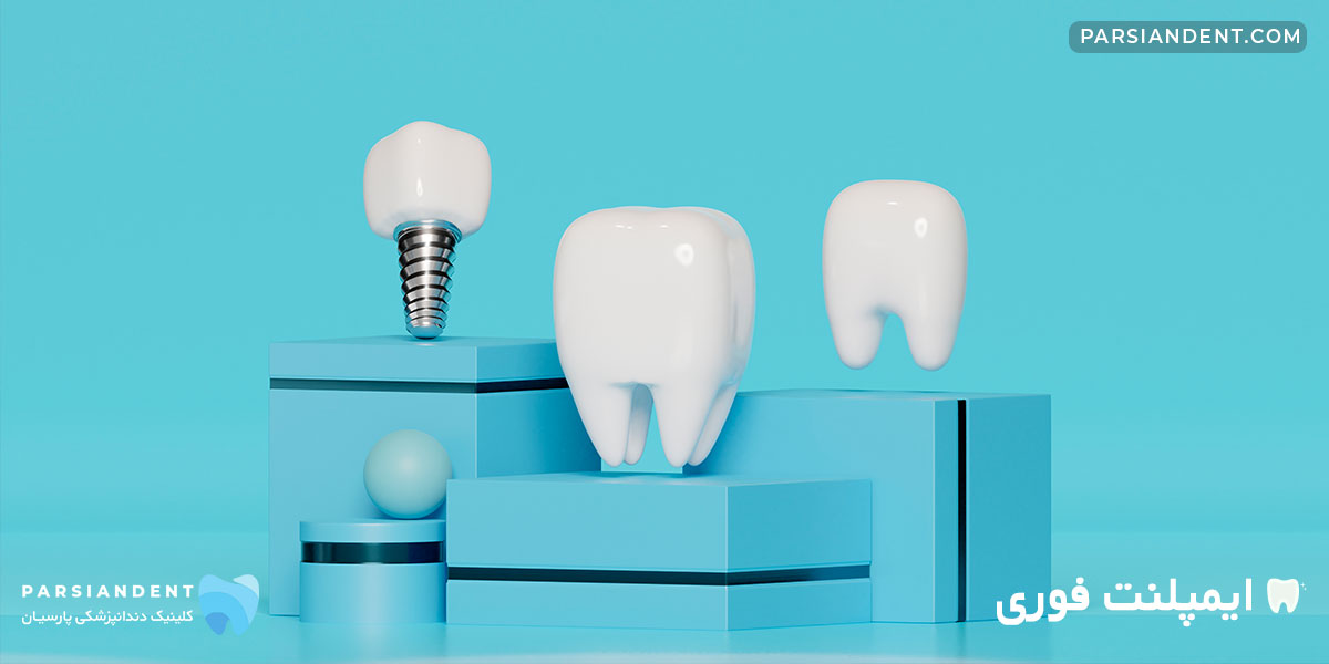 ایمپلنت فوری