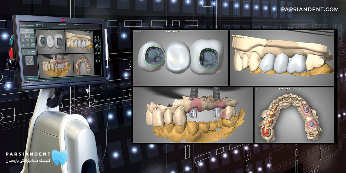 ایمپلنت دندان سه بعدی