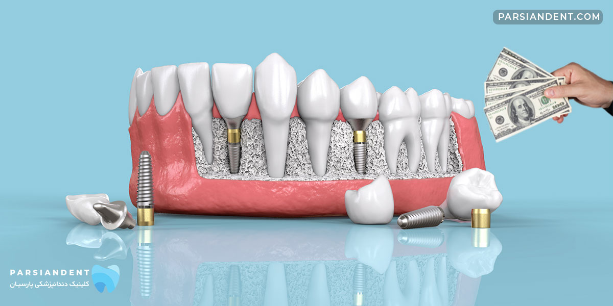 قیمت ایمپلنت دندان فوری