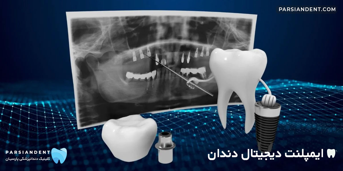 ایمپلنت دیجیتال دندان