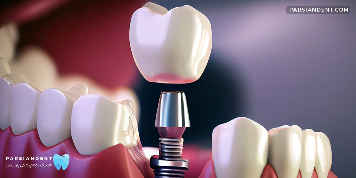 ایمپلنت فوری