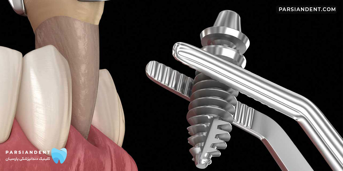 روش های کاشت ایمپلنت فوری