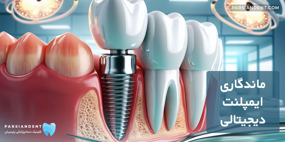 ماندگاری ایمپلنت دیجیتالی