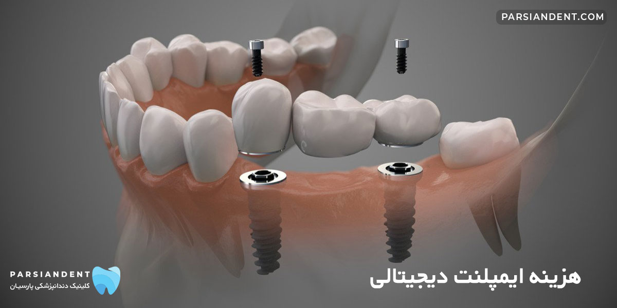 هزینه ایمپلنت دیجیتالی
