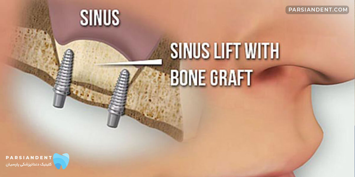 پیوند استخوان