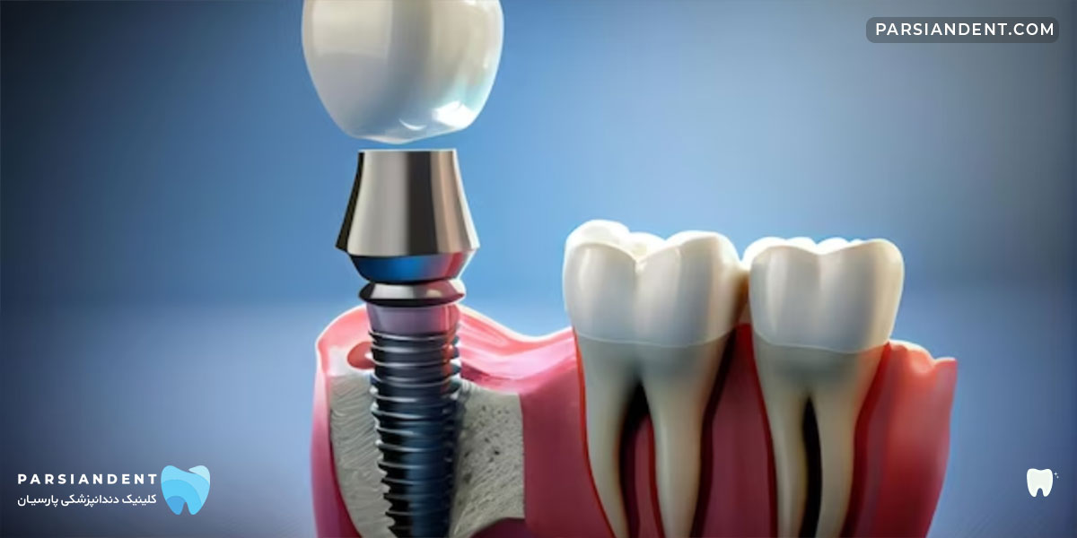 مراقبت های ایمپلنت فوری