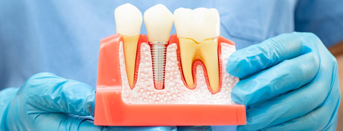 ایمپلنت فوری بدون بخیه
