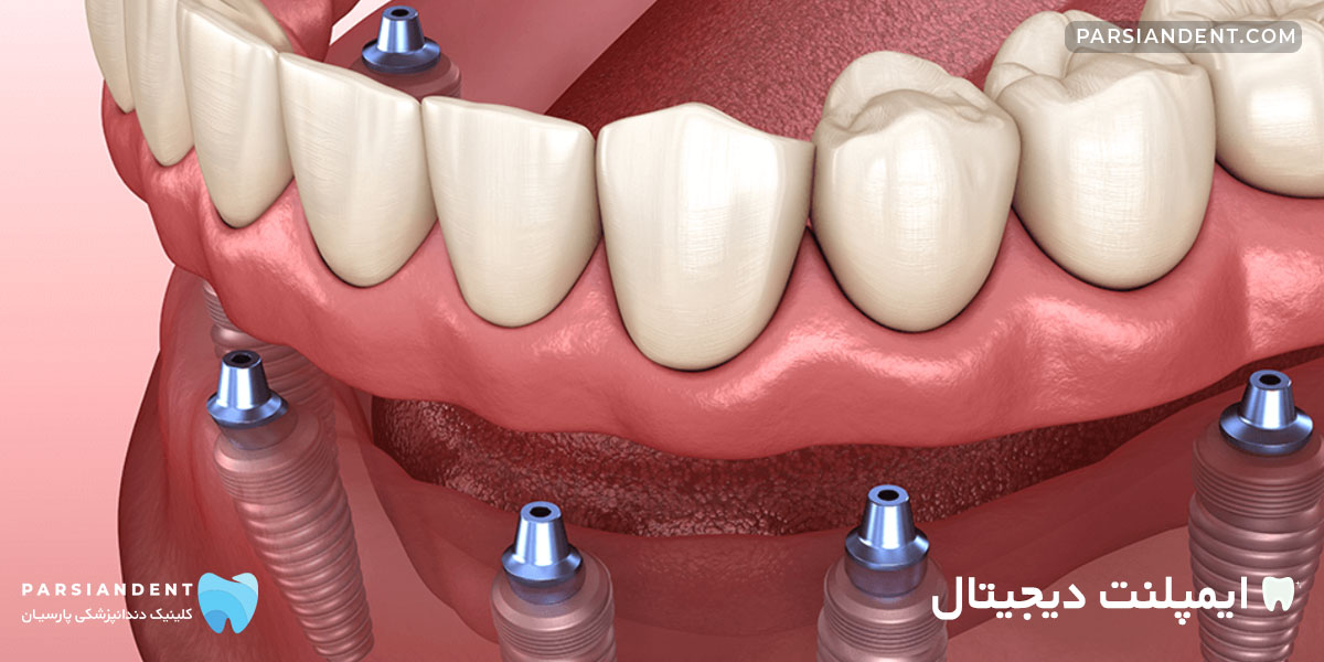 قیمت ایمپلنت دندان دیجیتال