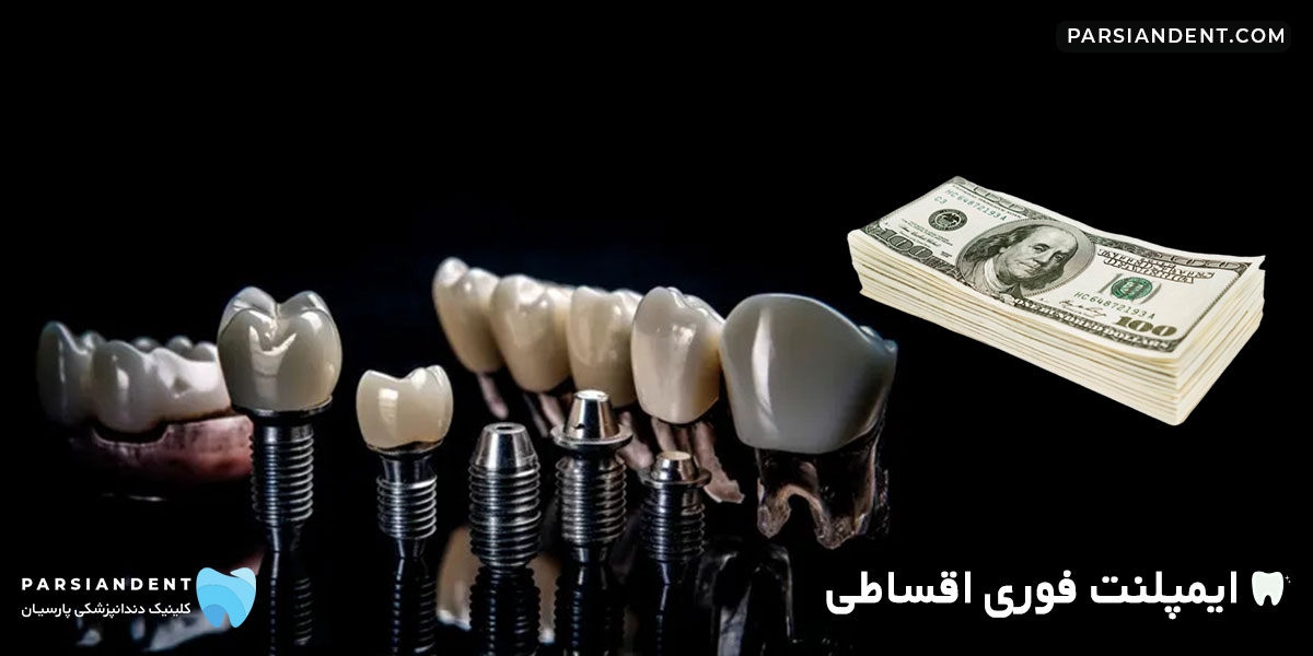ایمپلنت فوری اقساطی
