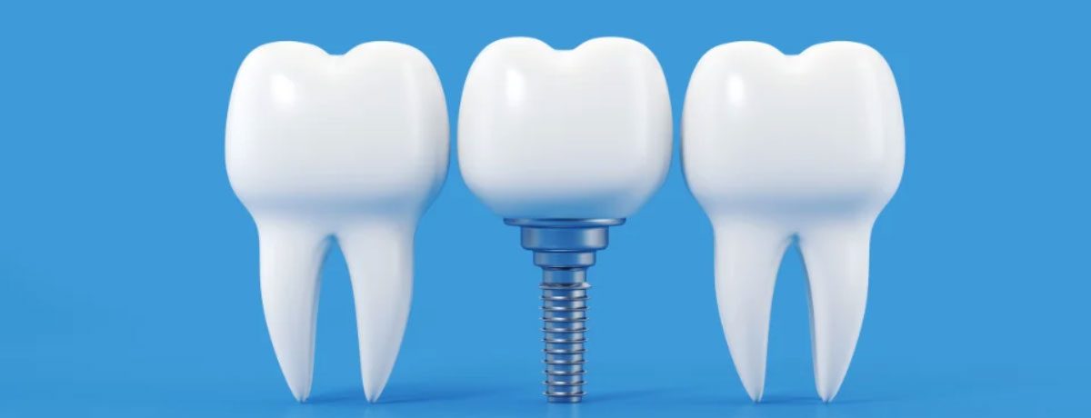 ایمپلنت فوری بدون بخیه