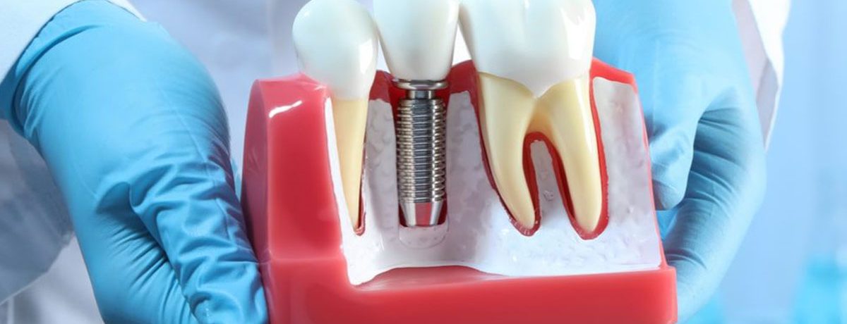 ایمپلنت فوری بدون بخیه تهران