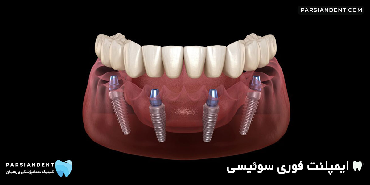 ایمپلنت فوری سوئیسی