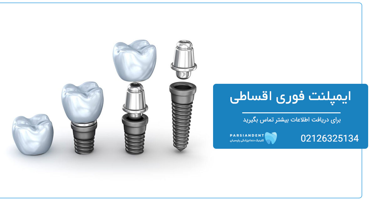 ایمپلنت فوری اقساطی