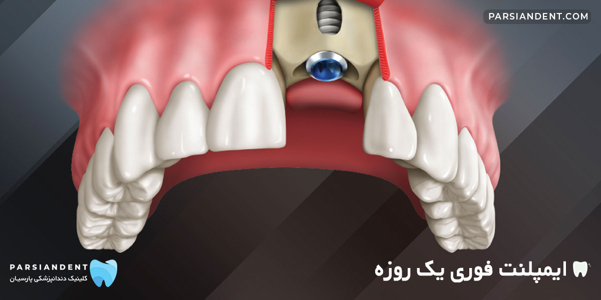 ایمپلنت فوری یک روزه دندان