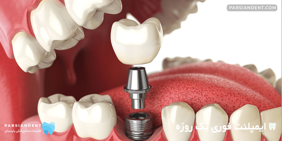 ایمپلنت فوری یک روزه