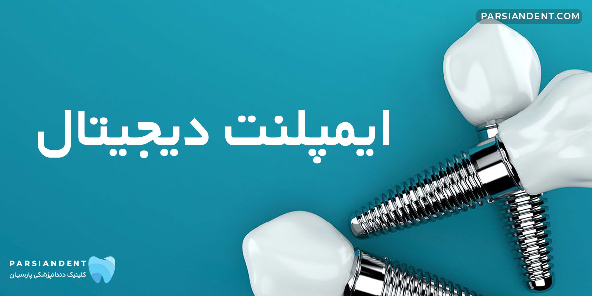 قیمت ایمپلنت دیجیتال هروی