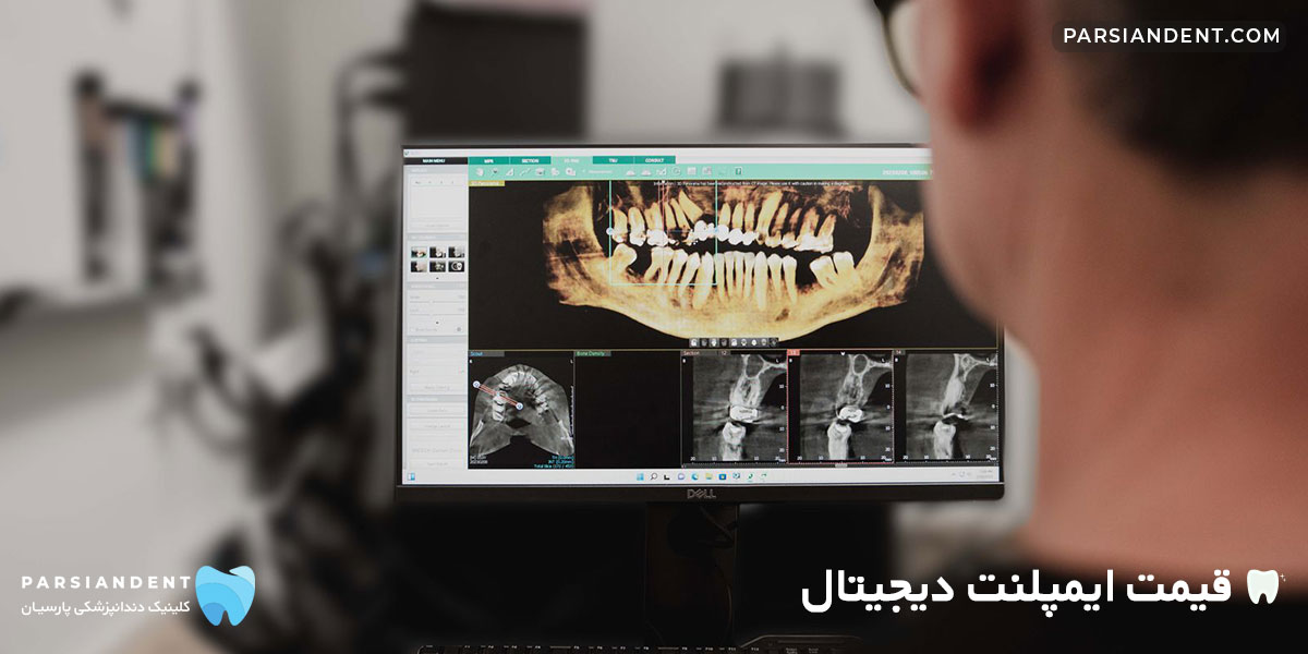 قیمت ایمپلنت دیجیتال