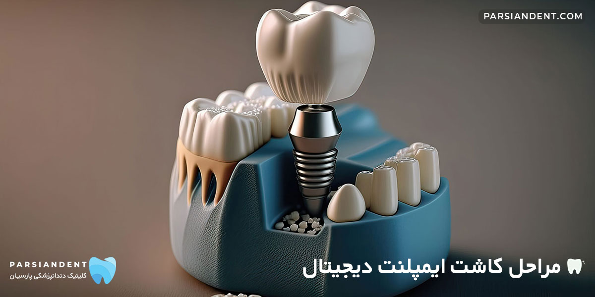 مراحل کاشت ایمپلنت دیجیتال