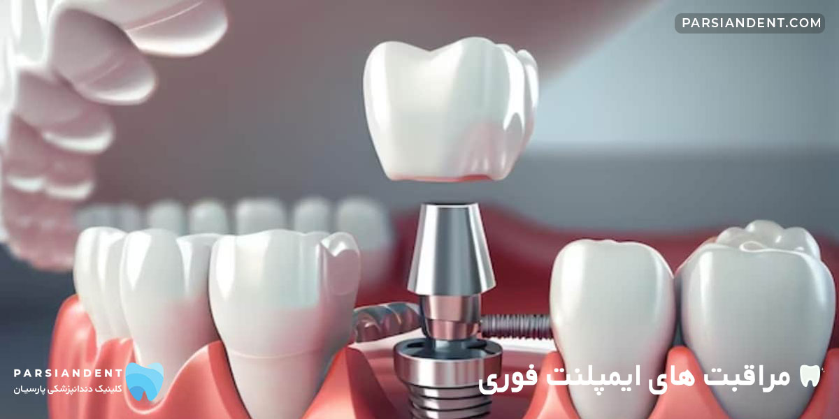 مراقبت های ایمپلنت فوری