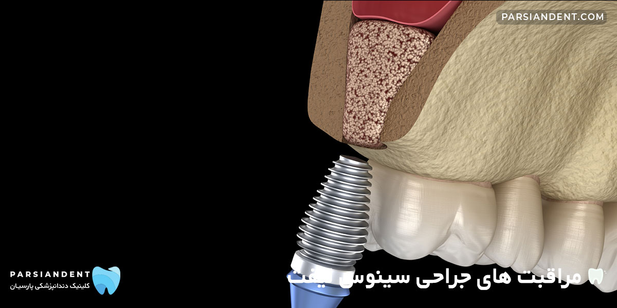 مراقبت های جراحی سینوس لیفت