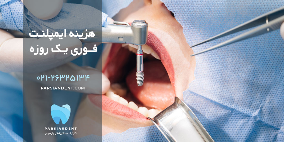 هزینه ایمپلنت فوری یک روزه