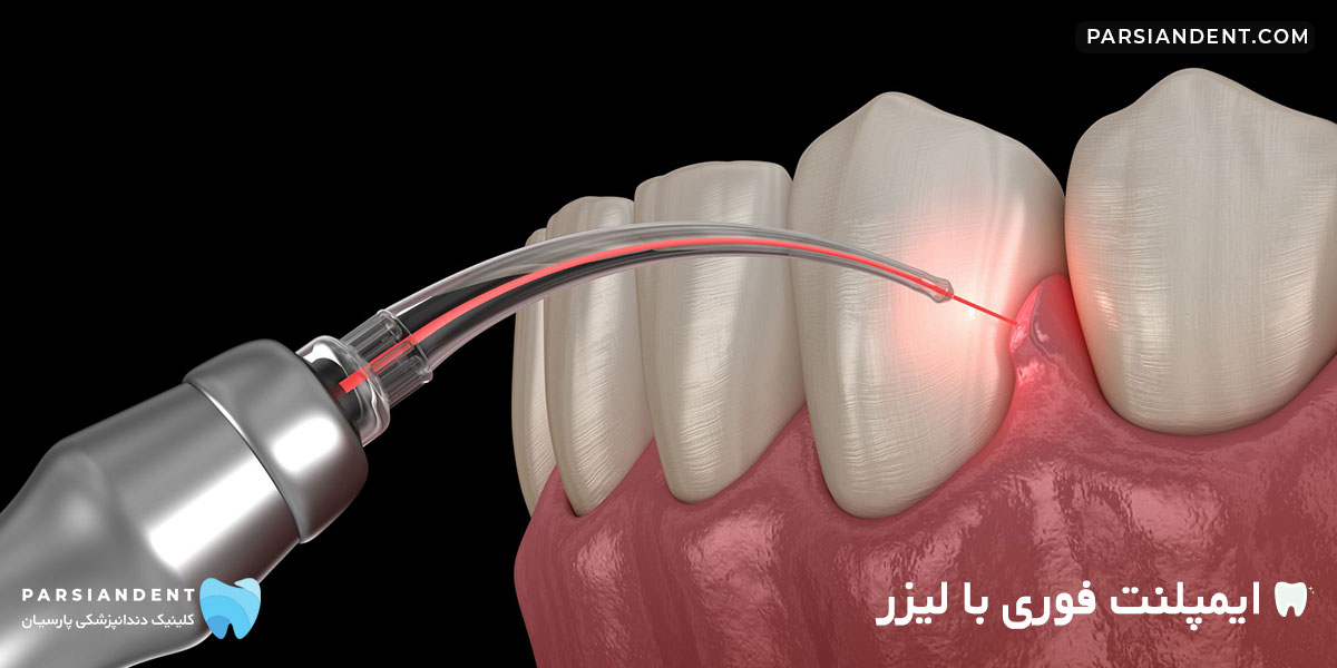 ایمپلنت فوری با لیزر