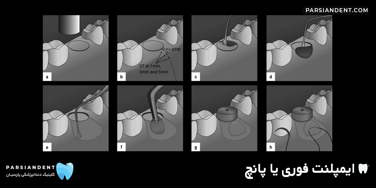 ایمپلنت فوری یا پانچ