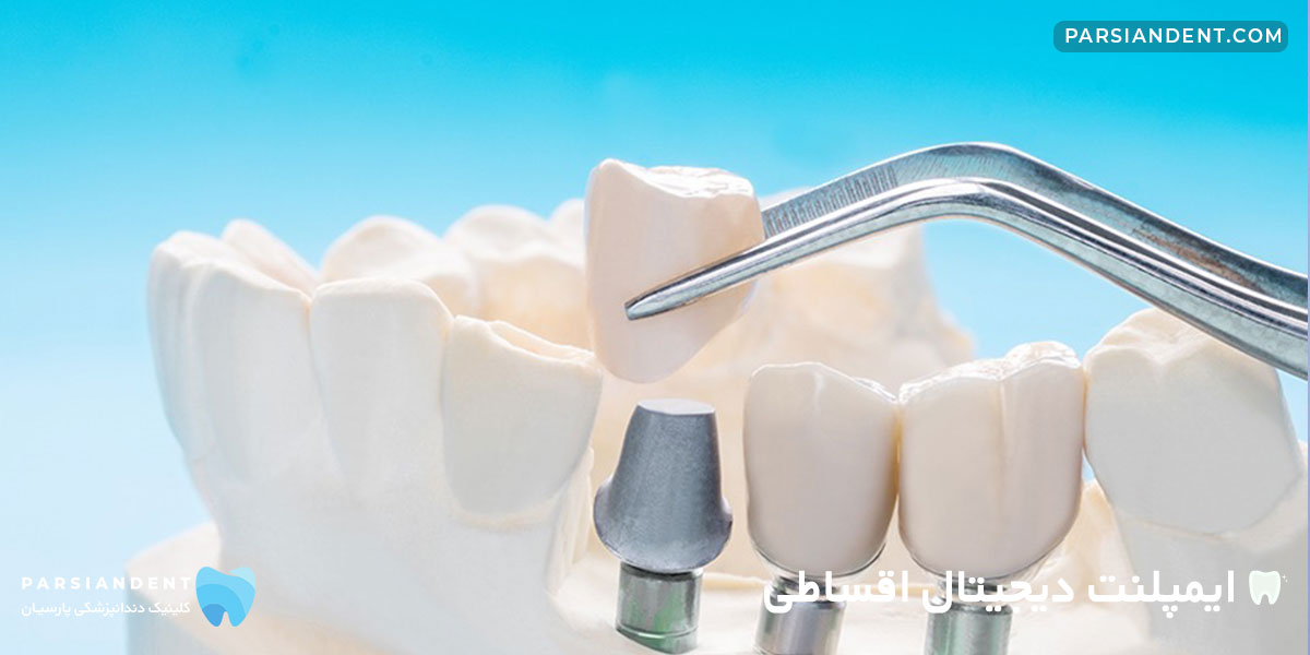 ایمپلنت دیجیتال اقساطی