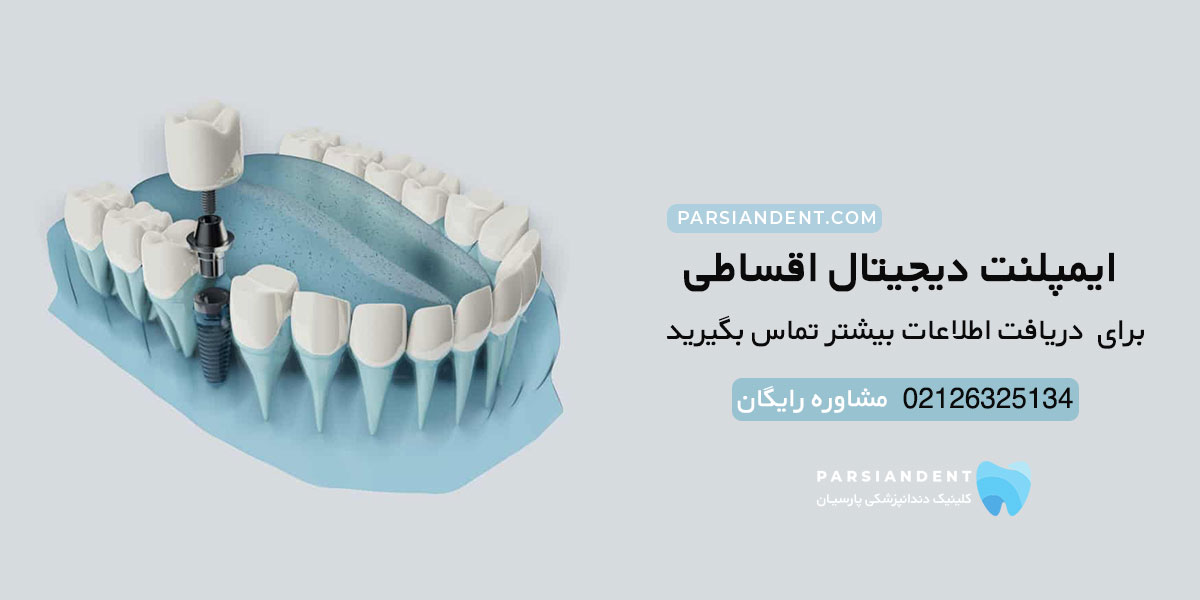 ایمپلنت دیجیتال قسطی در تهران