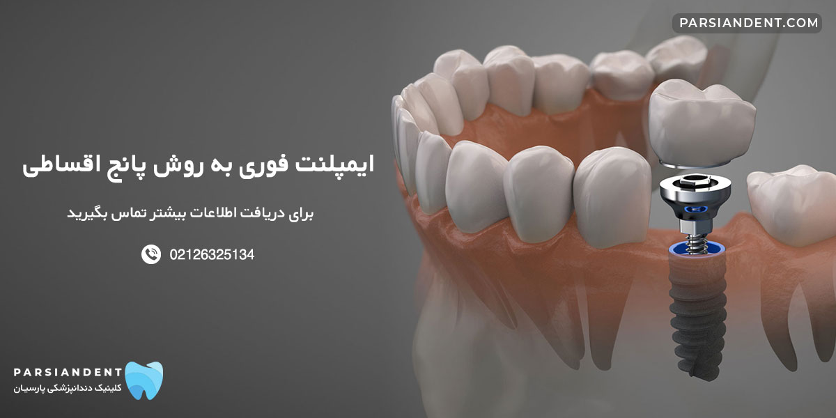 ایمپلنت فوری با پانچ اقساطی