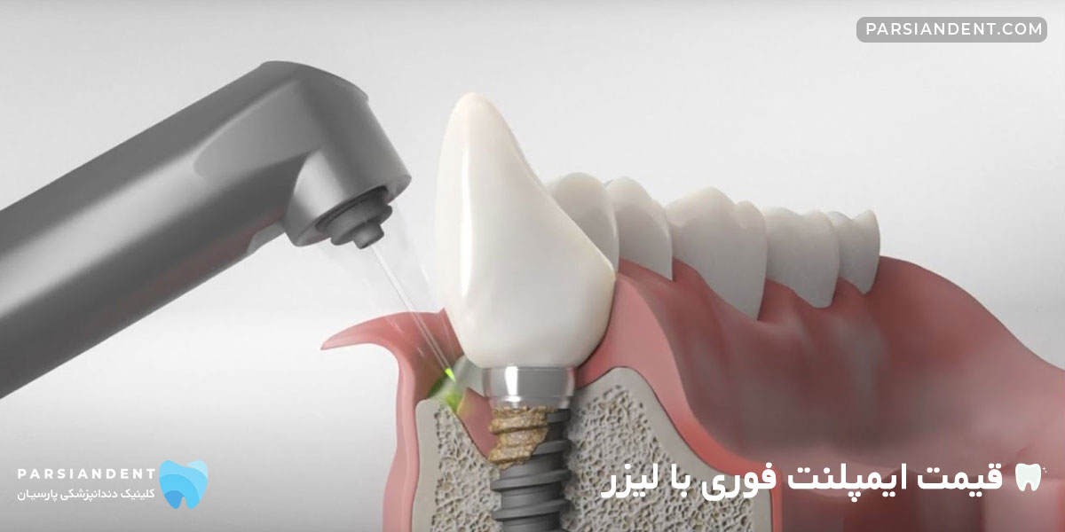 قیمت ایمپلنت فوری با لیزر