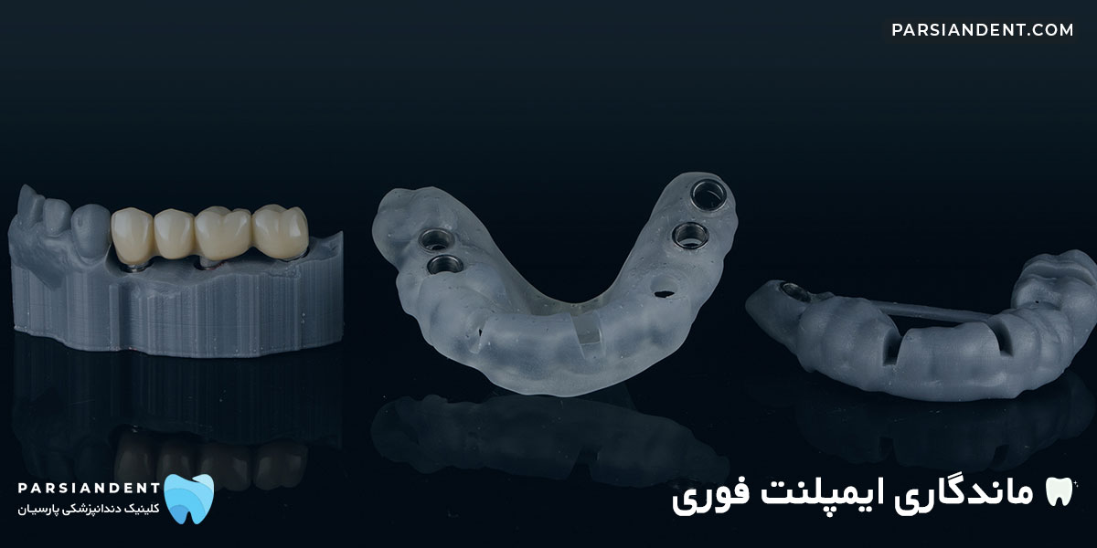 ماندگاری ایمپلنت فوری