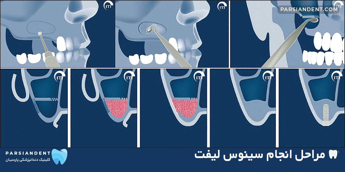 مراحل انجام سینوس لیفت