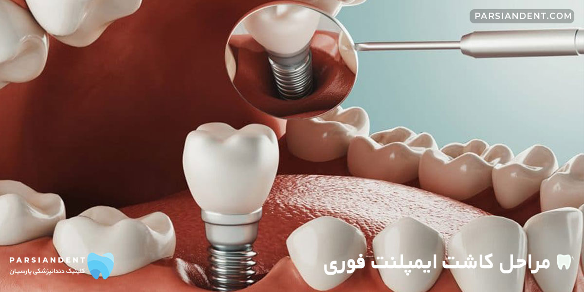 مراحل کاشت ایمپلنت فوری