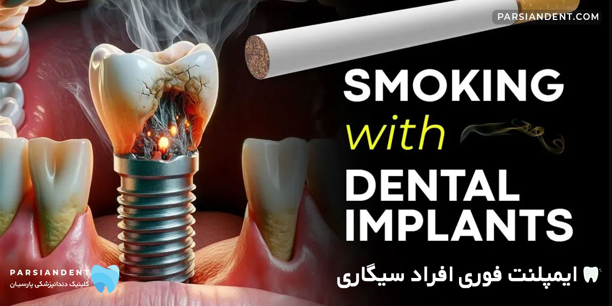 ایمپلنت فوری افراد سیگاری