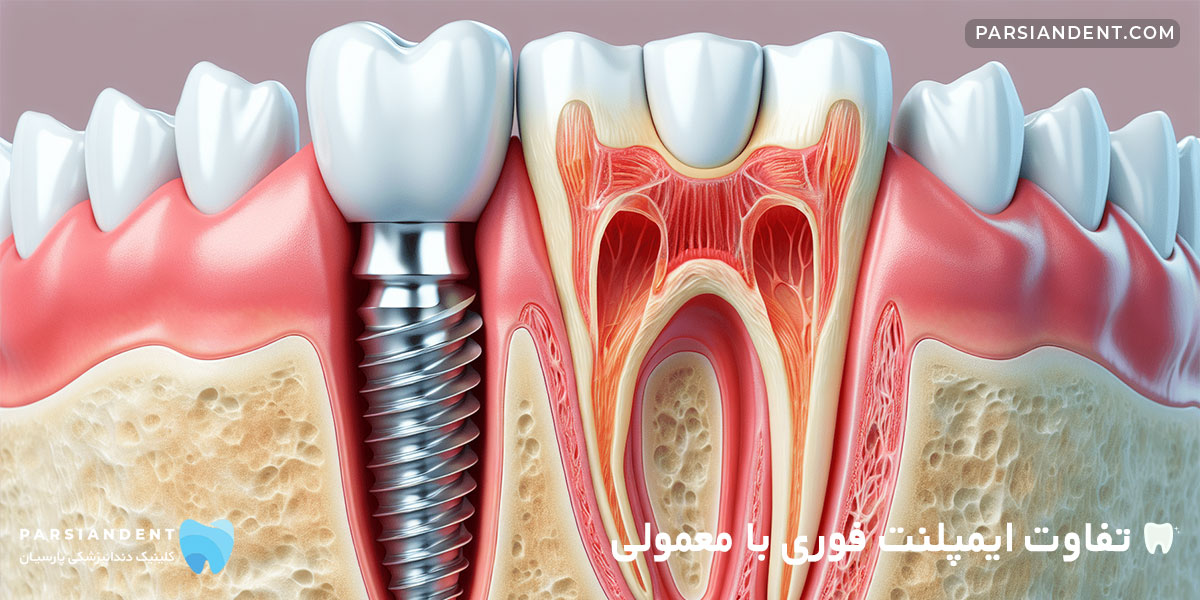 تفاوت ایمپلنت فوری با معمولی
