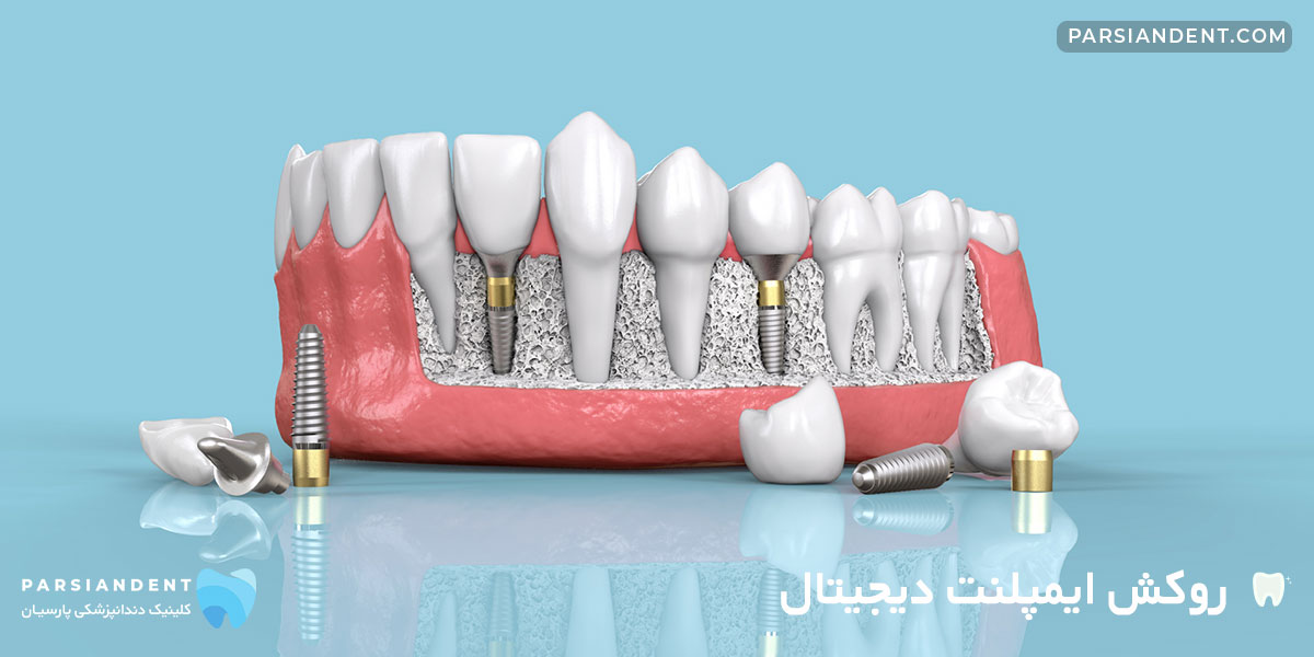 روکش ایمپلنت دیجیتال