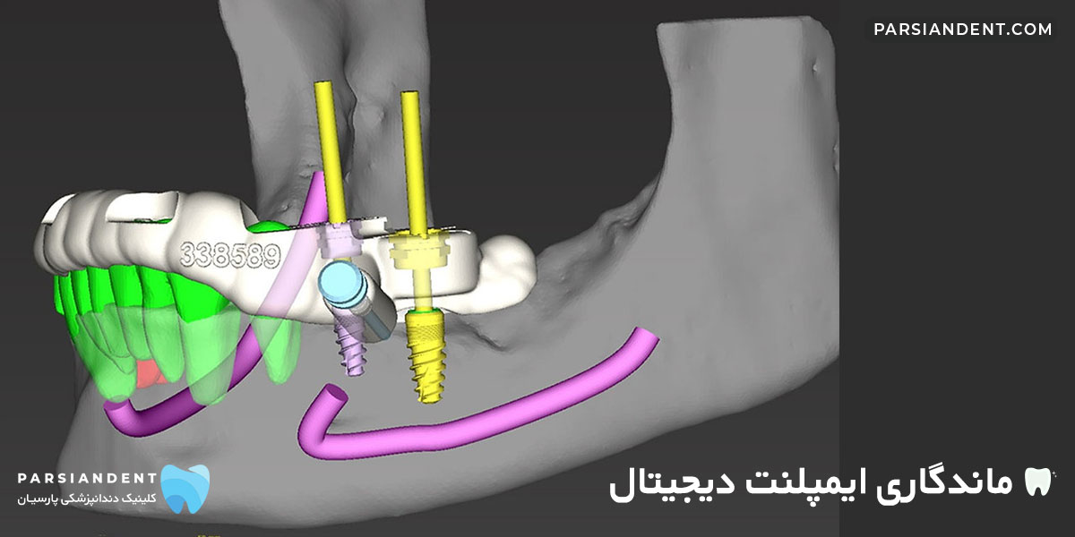 ماندگاری ایمپلنت دیجیتال