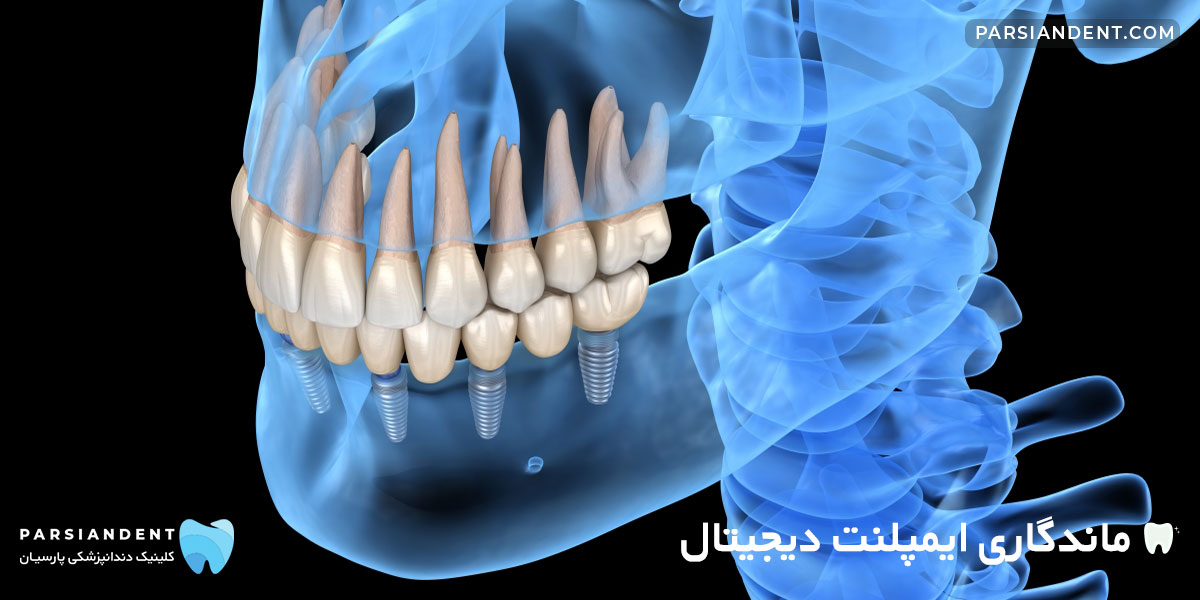 ماندگاری ایمپلنت دیجیتال