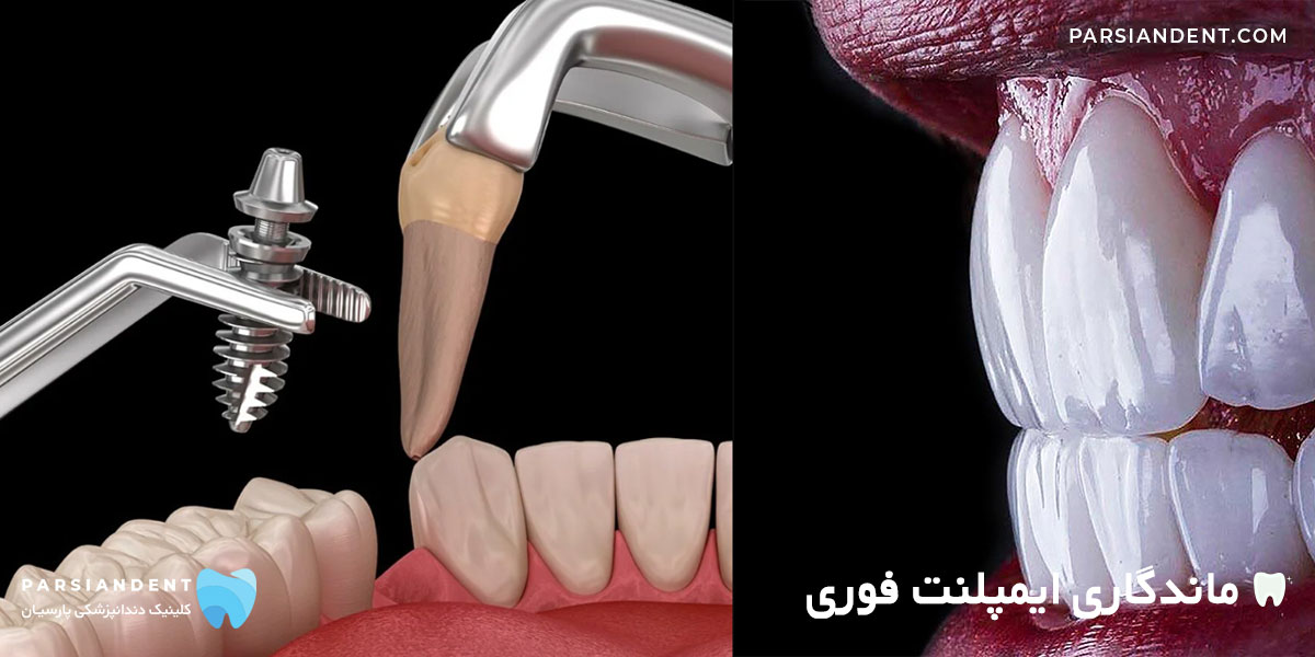 ماندگاری ایمپلنت فوری