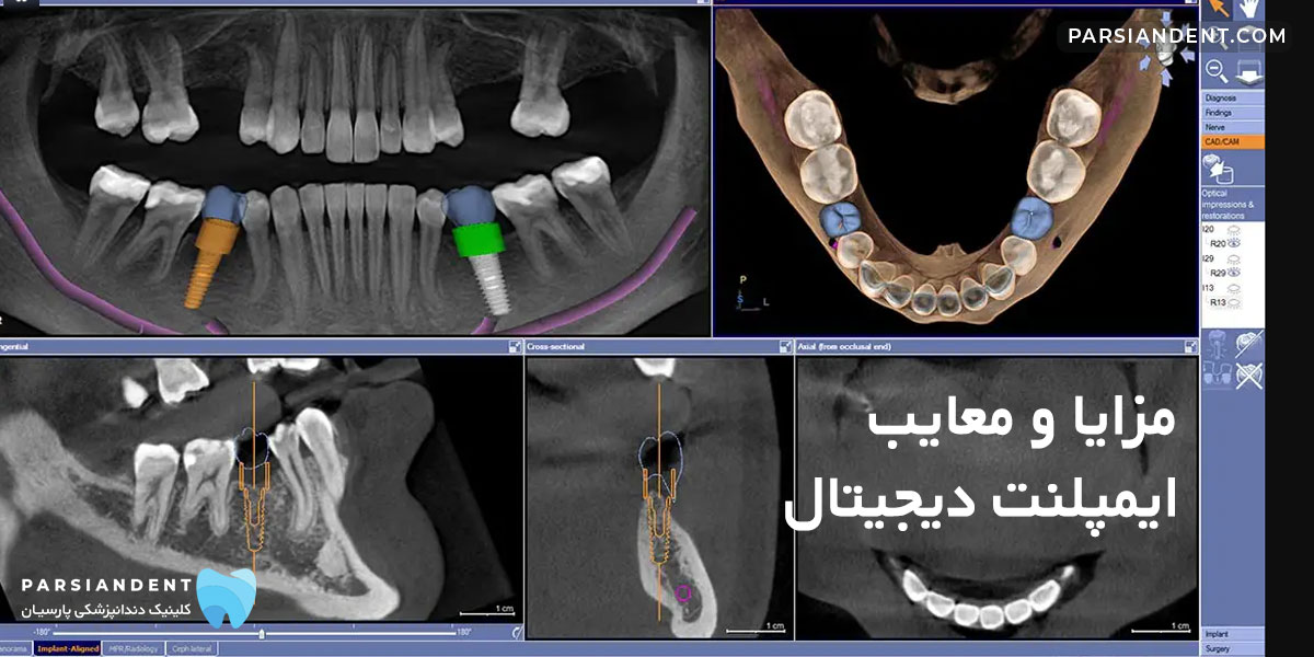 مزایا ایمپلنت دیجیتال