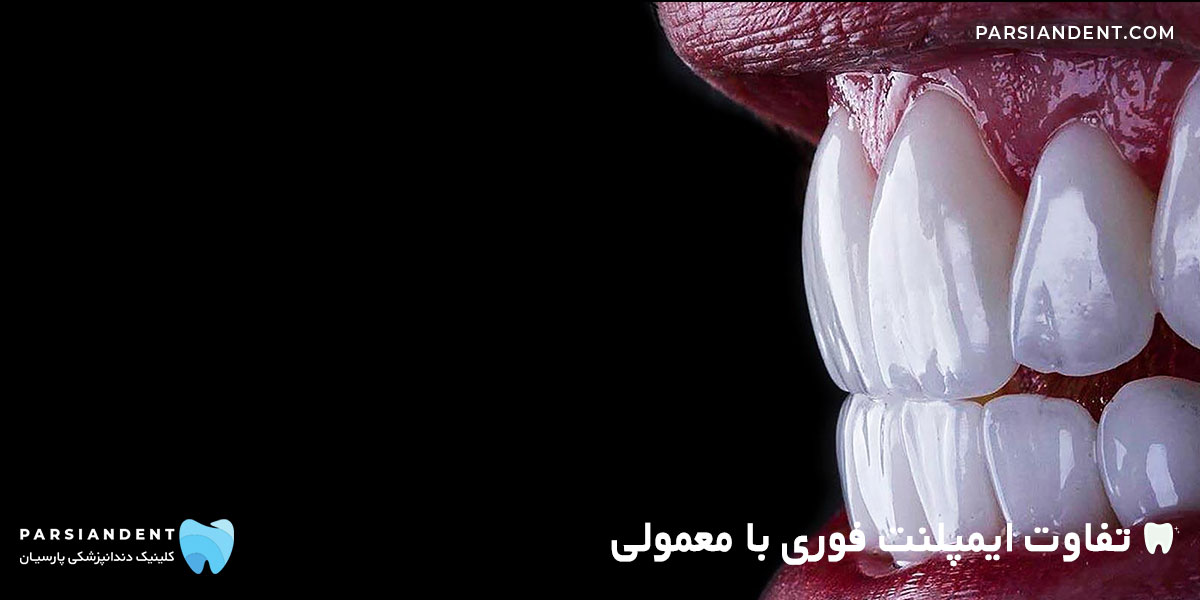 مقایسه ایمپلنت معمولی و فوری