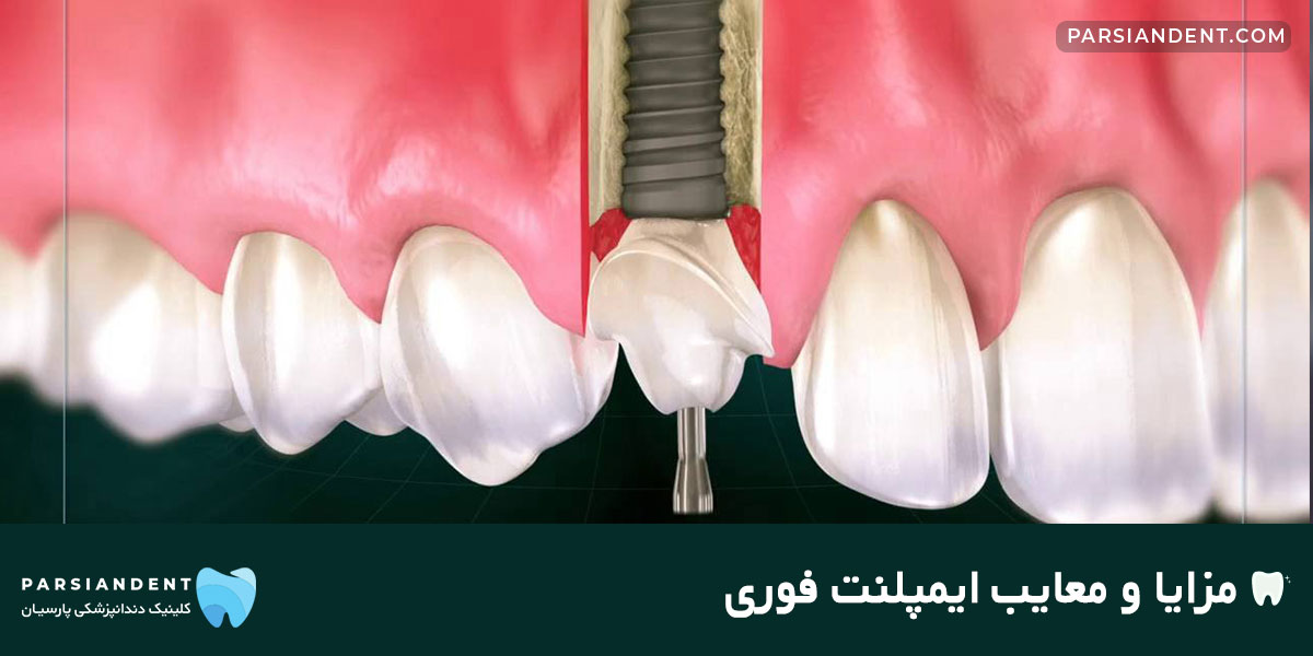 مزایا و معایب ایمپلنت فوری