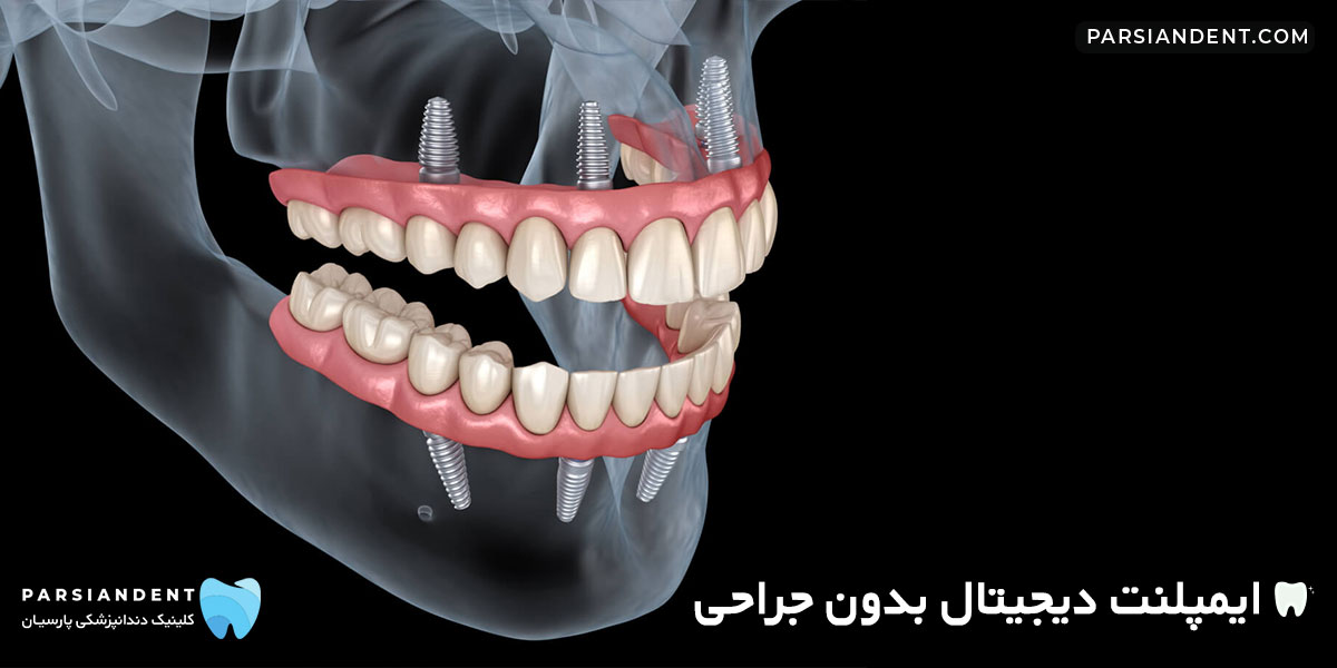 ایمپلنت دیجیتال بدون جراحی
